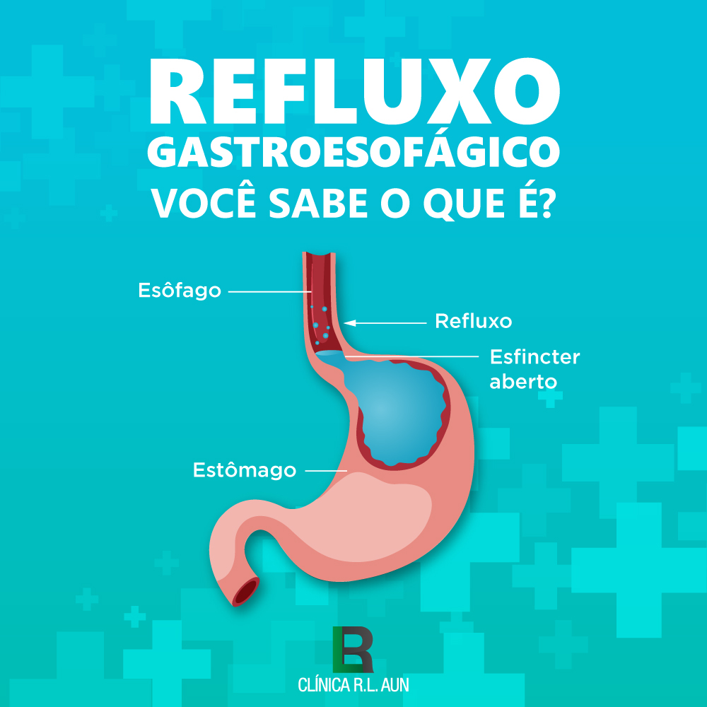 Refluxo Gastroesofágico Sintomas Causas E Tratamento Euroclinix Sexiz Pix